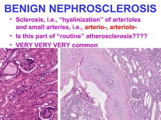 BENIGN NEPHROSCLEROSIS
• Sclerosis, i.e., “hyalinization” of arterioles
and small arteries, i.e., arterio-, arteriolo-
• Is this part of “routine” atherosclerosis????
• VERY VERY VERY common
 