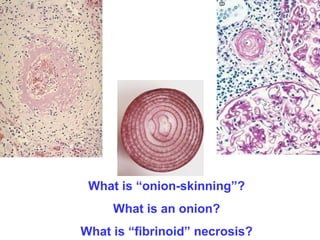 What is “onion-skinning”?
What is an onion?
What is “fibrinoid” necrosis?
 