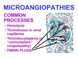 MICROANGIOPATHIES
COMMON
PROCESSES
–Hemolysis
–Thromboses in renal
capillaries
–Thrombocytopenia (a
“consumption”
coagulopathy)
–FIBRIN PLUGS
 