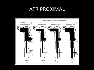 ATR PROXIMAL
 