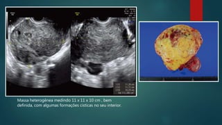 Massa heterogênea medindo 11 x 11 x 10 cm , bem
definida, com algumas formações cisticas no seu interior.
 