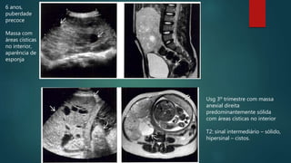 6 anos,
puberdade
precoce
Massa com
áreas císticas
no interior,
aparência de
esponja
Usg 3º trimestre com massa
anexial direita
predominantemente sólida
com áreas císticas no interior
T2: sinal intermediário – sólido,
hipersinal – cistos.
 