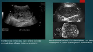 Massa ovariana medindo 11 cm, heterogênea, com áreas
hipoecogênicas e focos hiperecogênicos no seu interior.
Grande massa complexa na região anexial esquerda
contendo áreas sólidas e císticas no seu interior.
 