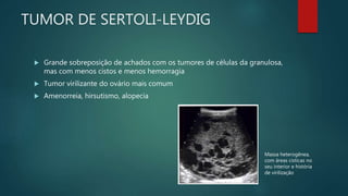 TUMOR DE SERTOLI-LEYDIG
 Grande sobreposição de achados com os tumores de células da granulosa,
mas com menos cistos e menos hemorragia
 Tumor virilizante do ovário mais comum
 Amenorreia, hirsutismo, alopecia
Massa heterogênea,
com áreas císticas no
seu interior e história
de virilização
 