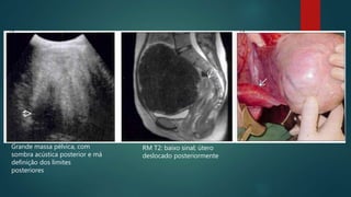 Grande massa pélvica, com
sombra acústica posterior e má
definição dos limites
posteriores
RM T2: baixo sinal; útero
deslocado posteriormente
 