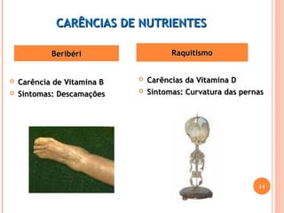 CCAARRÊÊNNCCIIAASS DDEE NNUUTTRRIIEENNTTEESS 
BBeerriibbéérrii RRaaqquuiittiissmmoo 
 CCaarrêênncciiaa ddee VViittaammiinnaa BB 
 SSiinnttoommaass:: DDeessccaammaaççõõeess 
 CCaarrêênncciiaass ddaa VViittaammiinnaa DD 
 SSiinnttoommaass:: CCuurrvvaattuurraa ddaass ppeerrnnaass 
14 
 