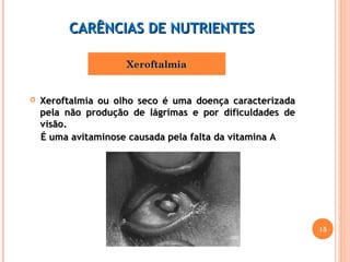 XXeerrooffttaallmmiiaa 
 Xeroftalmia ou olho seco é uma ddooeennççaa ccaarraacctteerriizzaaddaa 
ppeellaa nnããoo pprroodduuççããoo ddee lláággrriimmaass ee ppoorr ddiiffiiccuullddaaddeess ddee 
vviissããoo.. 
15 
CCAARRÊÊNNCCIIAASS DDEE NNUUTTRRIIEENNTTEESS 
ÉÉ uummaa aavviittaammiinnoossee ccaauussaaddaa ppeellaa ffaallttaa ddaa vviittaammiinnaa AA 
 
