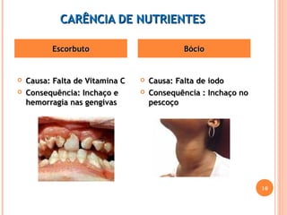 CCAARRÊÊNNCCIIAA DDEE NNUUTTRRIIEENNTTEESS 
EEssccoorrbbuuttoo BBóócciioo 
 CCaauussaa:: FFaallttaa ddee VViittaammiinnaa CC 
 CCoonnsseeqquuêênncciiaa:: IInncchhaaççoo ee 
hheemmoorrrraaggiiaa nnaass ggeennggiivvaass 
 CCaauussaa:: FFaallttaa ddee iiooddoo 
 CCoonnsseeqquuêênncciiaa :: IInncchhaaççoo nnoo 
ppeessccooççoo 
16 
 