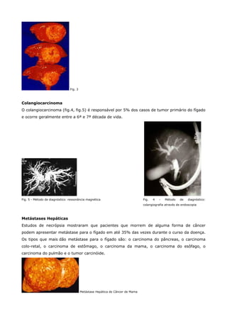 Fig. 3

Colangiocarcinoma
O colangiocarcinoma (fig.4, fig.5) é responsável por 5% dos casos de tumor primário do fígado
e ocorre geralmente entre a 6ª e 7ª década de vida.

Fig. 5 - Método de diagnóstico: ressonância magnética

Fig.

4

-

Método

de

diagnóstico:

colangiografia através de endoscopia

Metástases Hepáticas
Estudos de necrópsia mostraram que pacientes que morrem de alguma forma de câncer
podem apresentar metástase para o fígado em até 35% das vezes durante o curso da doença.
Os tipos que mais dão metástase para o fígado são: o carcinoma do pâncreas, o carcinoma
colo-retal, o carcinoma de estômago, o carcinoma da mama, o carcinoma do esôfago, o
carcinoma do pulmão e o tumor carcinóide.

Metástase Hepática de Câncer de Mama

 