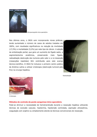 Ultrassonografia intra-operatória

Nos últimos anos, o INCA vem incorporando novas práticas,
tendo aumentado o número de casos de adultos tratados em
300%, com resultados significativos na redução da morbidade
(17,5%) e mortalidade (5,2%) por este tipo de câncer. A adoção
da embolização portal, que gera um aumento do fígado sadio, a
segmentectomia

anatômica,

preservando

mais

figado,

radioablação destruição dos tumores pelo calor e a re-ressecção
(ressecções

repetidas)

têm

contribuído

para

este

avanço

técnico-científico. O INCA foi inclusive o primeiro centro público
da América Latina a utilizar crioterapia (destruição tumoral pelo
frio) na cirurgia hepática.
Radioablação

Crioterapia

Métodos de controle da perda sanguínea intra-operatória
Pode-se diminuir a necessidade de hemotransfusão durante a ressecção hepática utilizando
técnicas de exclusão vascular, hipotermia, hipotensão controlada, aspiração ultrassônica,
coagulação com argônio ou simplesmente atendo às técnicas convencionais de ressecção.

 