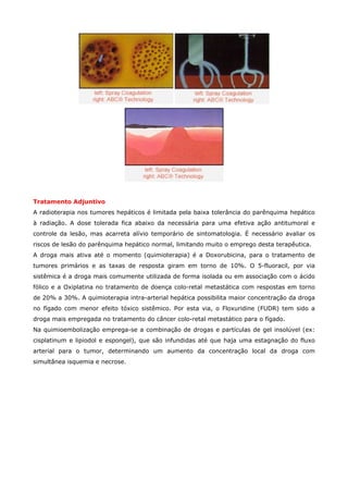 Tratamento Adjuntivo
A radioterapia nos tumores hepáticos é limitada pela baixa tolerância do parênquima hepático
à radiação. A dose tolerada fica abaixo da necessária para uma efetiva ação antitumoral e
controle da lesão, mas acarreta alívio temporário de sintomatologia. É necessário avaliar os
riscos de lesão do parênquima hepático normal, limitando muito o emprego desta terapêutica.
A droga mais ativa até o momento (quimioterapia) é a Doxorubicina, para o tratamento de
tumores primários e as taxas de resposta giram em torno de 10%. O 5-fluoracil, por via
sistêmica é a droga mais comumente utilizada de forma isolada ou em associação com o ácido
fólico e a Oxiplatina no tratamento de doença colo-retal metastática com respostas em torno
de 20% a 30%. A quimioterapia intra-arterial hepática possibilita maior concentração da droga
no fígado com menor efeito tóxico sistêmico. Por esta via, o Floxuridine (FUDR) tem sido a
droga mais empregada no tratamento do câncer colo-retal metastático para o fígado.
Na quimioembolização emprega-se a combinação de drogas e partículas de gel insolúvel (ex:
cisplatinum e lipiodol e espongel), que são infundidas até que haja uma estagnação do fluxo
arterial para o tumor, determinando um aumento da concentração local da droga com
simultânea isquemia e necrose.

 