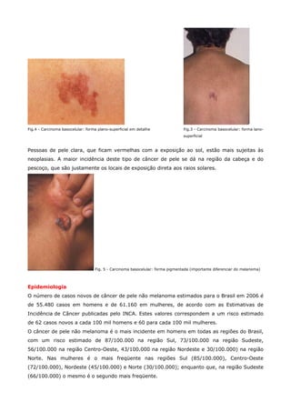 Fig.4 - Carcinoma basocelular: forma plano-superficial em detalhe

Fig.3 - Carcinoma basocelular: forma lanosuperficial

Pessoas de pele clara, que ficam vermelhas com a exposição ao sol, estão mais sujeitas às
neoplasias. A maior incidência deste tipo de câncer de pele se dá na região da cabeça e do
pescoço, que são justamente os locais de exposição direta aos raios solares.

Fig. 5 - Carcinoma basocelular: forma pigmentada (importante diferenciar do melanoma)

Epidemiologia
O número de casos novos de câncer de pele não melanoma estimados para o Brasil em 2006 é
de 55.480 casos em homens e de 61.160 em mulheres, de acordo com as Estimativas de
Incidência de Câncer publicadas pelo INCA. Estes valores correspondem a um risco estimado
de 62 casos novos a cada 100 mil homens e 60 para cada 100 mil mulheres.
O câncer de pele não melanoma é o mais incidente em homens em todas as regiões do Brasil,
com um risco estimado de 87/100.000 na região Sul, 73/100.000 na região Sudeste,
56/100.000 na região Centro-Oeste, 43/100.000 na região Nordeste e 30/100.000) na região
Norte. Nas mulheres é o mais freqüente nas regiões Sul (85/100.000), Centro-Oeste
(72/100.000), Nordeste (45/100.000) e Norte (30/100.000); enquanto que, na região Sudeste
(66/100.000) o mesmo é o segundo mais freqüente.

 
