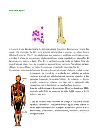 Leucemia Aguda

A leucemia é uma doença maligna dos glóbulos brancos (leucócitos) de origem, na maioria das
vezes, não conhecida. Ela tem como principal característica o acúmulo de células jovens
(blásticas) anormais (Fig. 1) na medula óssea, que substituem as células sangüineas normais.
A medula é o local de formação das células sangüíneas, ocupa a cavidade dos ossos (Fig. 2)
(principalmente esterno e bacia) (Fig. 3) e é conhecida popularmente por tutano. Nela são
encontradas as células mães ou precursoras, que originam os elementos figurados do sangue:
glóbulos brancos, glóbulos vermelhos (hemácias ou eritrócitos) e plaquetas (Fig. 4).
Os principais sintomas da leucemia decorrem do acúmulo dessas células na medula óssea,
prejudicando ou impedindo a produção dos glóbulos vermelhos
(causando anemia), dos glóbulos brancos (causando infecções) e das
plaquetas (causando hemorragias).Depois de instalada, a doença
progride rapidamente, exigindo com isso que o tratamento seja
iniciado logo após o diagnóstico e a classificação da leucemia.
Segundo as Estimativas de Incidência de Câncer no Brasil para 2006,
publicadas pelo INCA, as leucemias atingirão 5.330 homens e 4.220
mulheres este ano.

O tipo de leucemia mais freqüente na criança é a leucemia linfóide
aguda (ou linfoblástica). A leucemia mielóide aguda é mais comum no
adulto. Esta última tem vários subtipos: mieloblástica (menos e mais
diferenciada), promielocítica, mielomonocítica, monocítica, eritrocítica
e megacariocítica.

 