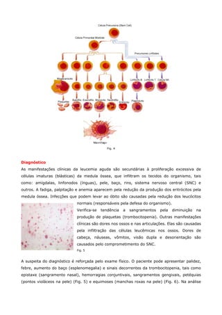 Fig. 4

Diagnóstico
As manifestações clínicas da leucemia aguda são secundárias à proliferação excessiva de
células imaturas (blásticas) da medula óssea, que infiltram os tecidos do organismo, tais
como: amígdalas, linfonodos (ínguas), pele, baço, rins, sistema nervoso central (SNC) e
outros. A fadiga, palpitação e anemia aparecem pela redução da produção dos eritrócitos pela
medula óssea. Infecções que podem levar ao óbito são causadas pela redução dos leucócitos
normais (responsáveis pela defesa do organismo).
Verifica-se

tendência

a

sangramentos

pela

diminuição

na

produção de plaquetas (trombocitopenia). Outras manifestações
clínicas são dores nos ossos e nas articulações. Elas são causadas
pela infiltração das células leucêmicas nos ossos. Dores de
cabeça, náuseas, vômitos, visão dupla e desorientação são
causados pelo comprometimento do SNC.
Fig. 5

A suspeita do diagnóstico é reforçada pelo exame físico. O paciente pode apresentar palidez,
febre, aumento do baço (esplenomegalia) e sinais decorrentes da trombocitopenia, tais como
epistaxe (sangramento nasal), hemorragias conjuntivais, sangramentos gengivais, petéquias
(pontos violáceos na pele) (Fig. 5) e equimoses (manchas roxas na pele) (Fig. 6). Na análise

 