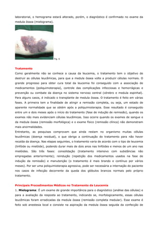 laboratorial, o hemograma estará alterado, porém, o diagnóstico é confirmado no exame da
medula óssea (mielograma).

Fig. 6

Tratamento
Como geralmente não se conhece a causa da leucemia, o tratamento tem o objetivo de
destruir as células leucêmicas, para que a medula óssea volte a produzir células normais. O
grande progresso para obter cura total da leucemia foi conseguido com a associação de
medicamentos (poliquimoterapia), controle das complicações infecciosas e hemorrágicas e
prevenção ou combate da doença no sistema nervoso central (cérebro e medula espinhal).
Para alguns casos, é indicado o transplante de medula óssea. O tratamento é feito em várias
fases. A primeira tem a finalidade de atingir a remissão completa, ou seja, um estado de
aparente normalidade que se obtém após a poliquimioterapia. Esse resultado é conseguido
entre um e dois meses após o início do tratamento (fase de indução de remissão), quando os
exames não mais evidenciam células leucêmicas. Isso ocorre quando os exames de sangue e
da medula óssea (remissão morfológica) e o exame físico (remissão clínica) não demonstram
mais anormalidades.
Entretanto, as pesquisas comprovam que ainda restam no organismo muitas células
leucêmicas (doença residual), o que obriga a continuação do tratamento para não haver
recaída da doença. Nas etapas seguintes, o tratamento varia de acordo com o tipo de leucemia
(linfóide ou mielóide), podendo durar mais de dois anos nas linfóides e menos de um ano nas
mielóides.

São

três

fases:

consolidação

(tratamento

intensivo

com

substâncias

não

empregadas anteriormente); reindução (repetição dos medicamentos usados na fase de
indução da remissão) e manutenção (o tratamento é mais brando e contínuo por vários
meses). Por ser uma poliquimioterapia agressiva, pode ser necessária a internação do paciente
nos casos de infecção decorrente da queda dos glóbulos brancos normais pelo próprio
tratamento.
Principais Procedimentos Médicos no Tratamento da Leucemia
1. Mielograma: É um exame de grande importância para o diagnóstico (análise das células) e
para a avaliação da resposta ao tratamento, indicando se, morfologicamente, essas células
leucêmicas foram erradicadas da medula óssea (remissão completa medular). Esse exame é
feito sob anestesia local e consiste na aspiração da medula óssea seguida da confecção de

 