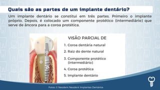 Quais são as partes de um implante dentário?
Um implante dentário se constitui em três partes. Primeiro o implante
próprio. Depois, é colocado um componente protético (intermediário) que
serve de âncora para a coroa protética.
VISÃO PARCIAL DE
1. Coroa dentária natural
2. Raiz do dente natural
3. Componente protético
(intermediário)
4. Coroa protética
5. Implante dentário
Fotos: © Neodent Neodent Implantes Dentários
 