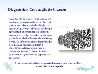 A graduação de Gleason é utilizada para
avaliar ou graduar as células de câncer de
próstata obtidas através de biópsia por
agulha. O patologista buscará células que
apresentem anormalidades e também
analisará os tecidos retirados na biópsia a
partir da escala de Gleason, dividida em 5
níveis. Os diferentes níveis determinados
pela Escala de Gleason ajudam a
identificar as chances do câncer se
disseminar (ou não). Esses níveis de 2
(tipo menos agressivo) a 10 (tipo muito
agressivo).
Diagnóstico: Graduação de Gleason
É importante identificar a agressividade do tumor para escolher o
tratamento mais adequado.
 