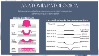 Boreman Classification Comprehensive Overview of Gastric Tumor Pathology and Treatment | PDF