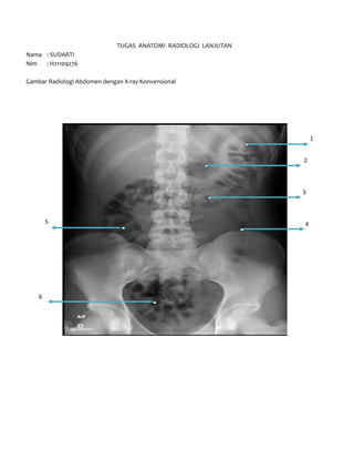 TUGAS ANATOMI RADIOLOGI LANJUTAN
Nama : SUDARTI
Nim
: H21109276
Gambar Radiologi Abdomen dengan X-ray Konvensional

1
2

3

5

6

4

 