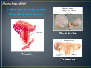 Gambar-gambar Gangguan Pada
 Sistem Reproduksi Manusia




                              Kanker ovarium.




          Prostatitis.

                               Endometriosis.
 