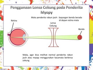 Mata penderita rabun jauh : bayangan benda berada
Retina                                      di depan retina mata
                                   Lensa
                                  Cekung
                                                                Benda




         Maka, agar bisa melihat normal penderita rabun
         jauh atau myopy menggunakan kacamata berlensa
         cekung
 