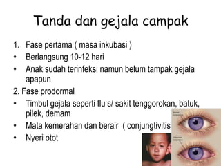 Tanda dan gejala campak
1. Fase pertama ( masa inkubasi )
• Berlangsung 10-12 hari
• Anak sudah terinfeksi namun belum tampak gejala
apapun
2. Fase prodormal
• Timbul gejala seperti flu s/ sakit tenggorokan, batuk,
pilek, demam
• Mata kemerahan dan berair ( conjungtivitis )
• Nyeri otot
 
