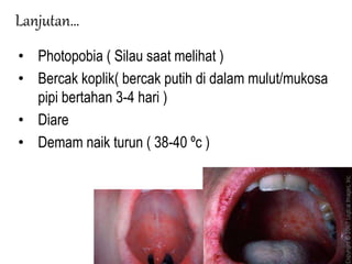Lanjutan…
• Photopobia ( Silau saat melihat )
• Bercak koplik( bercak putih di dalam mulut/mukosa
pipi bertahan 3-4 hari )
• Diare
• Demam naik turun ( 38-40 ºc )
 