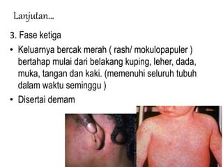 Lanjutan…
3. Fase ketiga
• Keluarnya bercak merah ( rash/ mokulopapuler )
bertahap mulai dari belakang kuping, leher, dada,
muka, tangan dan kaki. (memenuhi seluruh tubuh
dalam waktu seminggu )
• Disertai demam
 