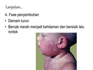Lanjutan…
4. Fase penyembuhan
• Demam turun
• Bercak merah menjadi kehitaman dan bersisik lalu
rontok
 