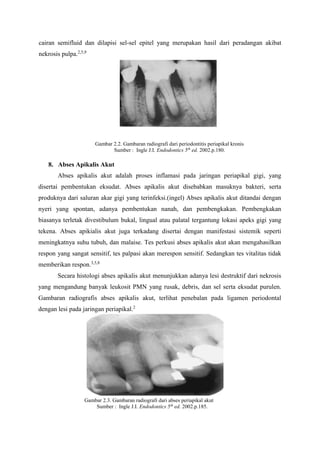 cairan semifluid dan dilapisi sel-sel epitel yang merupakan hasil dari peradangan akibat
nekrosis pulpa.2,5,9
Gambar 2.2. Gambaran radiografi dari periodontitis periapikal kronis
Sumber : Ingle J.I. Endodontics 5th
ed. 2002.p.180.
8. Abses Apikalis Akut
Abses apikalis akut adalah proses inflamasi pada jaringan periapikal gigi, yang
disertai pembentukan eksudat. Abses apikalis akut disebabkan masuknya bakteri, serta
produknya dari saluran akar gigi yang terinfeksi.(ingel) Abses apikalis akut ditandai dengan
nyeri yang spontan, adanya pembentukan nanah, dan pembengkakan. Pembengkakan
biasanya terletak divestibulum bukal, lingual atau palatal tergantung lokasi apeks gigi yang
tekena. Abses apikialis akut juga terkadang disertai dengan manifestasi sistemik seperti
meningkatnya suhu tubuh, dan malaise. Tes perkusi abses apikalis akut akan mengahasilkan
respon yang sangat sensitif, tes palpasi akan merespon sensitif. Sedangkan tes vitalitas tidak
memberikan respon.3,5,8
Secara histologi abses apikalis akut menunjukkan adanya lesi destruktif dari nekrosis
yang mengandung banyak leukosit PMN yang rusak, debris, dan sel serta eksudat purulen.
Gambaran radiografis abses apikalis akut, terlihat penebalan pada ligamen periodontal
dengan lesi pada jaringan periapikal.2
Gambar 2.3. Gambaran radiografi dari abses periapikal akut
Sumber : Ingle J.I. Endodontics 5th
ed. 2002.p.185.
 
