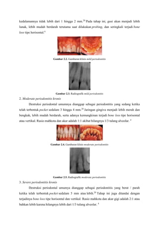 kedalamannya tidak lebih dari 1 hingga 2 mm.20
Pada tahap ini, gusi akan menjadi lebih
lunak, lebih mudah berdarah terutama saat dilakukan probing, dan seringkali terjadi bone
loss tipe horisontal.4
Gambar 2.2. Gambaran klinis mild periodontitis
Gambar 2.3. Radiografik mild periodontitis
2. Moderate periodontitis kronis
Destruksi periodontal umumnya dianggap sebagai periodontitis yang sedang ketika
telah terbentuk pocket sedalam 3 hingga 4 mm.20
Jaringan gingiva menjadi lebih merah dan
bengkak, lebih mudah berdarah, serta adanya kemungkinan terjadi bone loss tipe horisontal
atau vertikal. Rasio mahkota dan akar adalah 1:1 akibat hilangnya 1/3 tulang alveolar. 4
Gambar 2.4. Gambaran klinis moderate periodontitis
Gambar 2.5. Radiografik moderate periodontitis
3. Severe periodontitis kronis
Destruksi periodontal umumya dianggap sebagai periodontitis yang berat / parah
ketika telah terbentuk pocket sedalam 5 mm atau lebih.20
Tahap ini juga ditandai dengan
terjadinya bone loss tipe horisontal dan vertikal. Rasio mahkota dan akar gigi adalah 2:1 atau
bahkan lebih karena hilangnya lebih dari 1/3 tulang alveolar. 4
 
