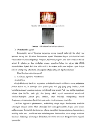 Gambar 2.6. Gambaran klinis severe periodontitis
Gambar 2.7 Radiografik severe periodontitis
2. Periodontitis agresif
Periodontitis agresif biasanya menyerang secara sistemik pada individu sehat yang
berumur kurang dari 30 tahun. Periodontitis agresif dibedakan dengan periodontitis kronis
berdasarkan usia mulai terjadinya pernyakit, kecepatan progresi, sifat dan komposisi bakteri
terkait di subgingiva, dan perubahan respon imun host. Selain itu Meyer dkk (2004)
menambahkan deposit kalkulus lebih sedikit, kerusakan perlekatan berjalan cepat dengan
periode tenang yang lebih lama, terjadi pada subyek sehat, dan dapat diturunkan.
Klasifikasi periodontitis agresif:
a. Localized Agressive Periodontitis
Gejala Klinis
Gelaja klinis dari localized aggressive periodontitis adalah terlihatnya deep periodontal
pocket. Selain itu, di beberapa kasus jumlah plak pada gigi yang yang terinfeksi, tidak
berimbang dengan kerusakan jaringan periodontal yang terjadi. Plak yang terlihat terdiri dari
selapis tipis biofilm pada gigi dan jarang sekali terjadi mineralisasi membentuk
calculus.Walaupun jumlah plak terbatas, tetapi biasanya mengandung banyak
A.actinomycetemcomitans.dan di beberapa pasien porphyromonas gingivalis.
Localized aggressive periodontitis, berkembang sangat cepat. Berdasarkan penelitian
kehilangan tulang 3 sampai 4 kali lebih cepat dari kronik periodontitis. Gejala klinis lainnya
adalah migrasi distolabial dari insisivus rahang atas diikuti dengan diastema, bertambahnya
mobility molar satu , sensitivitas akar terhadap panas, dan sentuhan, serta adanya nyeri saat
mastikasi. Pada stage ini mungkin ditemukan periodontal abscesses dan pembesaran regional
lymp node.
 