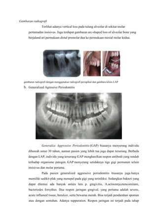 Gambaran radiografi
Terlihat adanya vertical loss pada tulang alveolar di sekitar molar
pertamadan insisivus. Juga terdapat gambaran arc-shaped loss of alveolar bone yang
berjaland ari permukaan distal premolar dua ke permukaan mesial molar kedua.
gambaran radiografi dengan menggunakan radiografi periapikal dan gambara klinis LAP
b. Generalized Agressive Periodontitis
Generalize Aggressive Periodontitis (GAP) biasanya menyerang individu
dibawah umur 30 tahun, namun pasien yang lebih tua juga dapat terserang. Berbeda
dengan LAP, individu yang terserang GAP menghasilkan respon antibodi yang rendah
terhadap organisme patogen. GAP menyerang setidaknya tiga gigi permanen selain
insisivus dan molar pertama.
Pada pasien generalized aggressive periodontitis biasanya juga hanya
memiliki sedikit plak yang menepel pada gigi yang terinfeksi. Sedangkan bakteri yang
dapat ditemui ada banyak antara lain p. gingivitis, A.actinomycetencomitans,
bacteriodes forsythus. Dua respon jaringan gingival, yang pertama adalah severe,
acute inflamed tissue, berulcer, serta bewarna merah. Bisa terjadi pendarahan spontan
atau dengan sentuhan. Adanya suppuration. Respon jaringan ini terjadi pada tahap
 