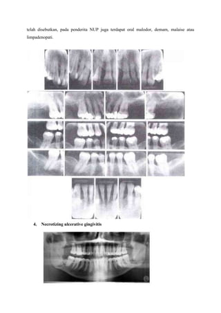 telah disebutkan, pada penderita NUP juga terdapat oral malodor, demam, malaise atau
limpadenopati.
4. Necrotizing ulcerative gingivitis
 