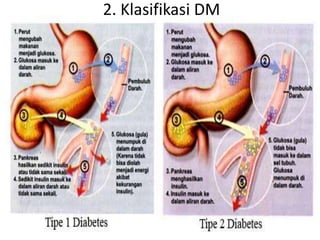 2. Klasifikasi DM
 