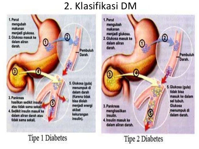 How it happened diabetes melitus