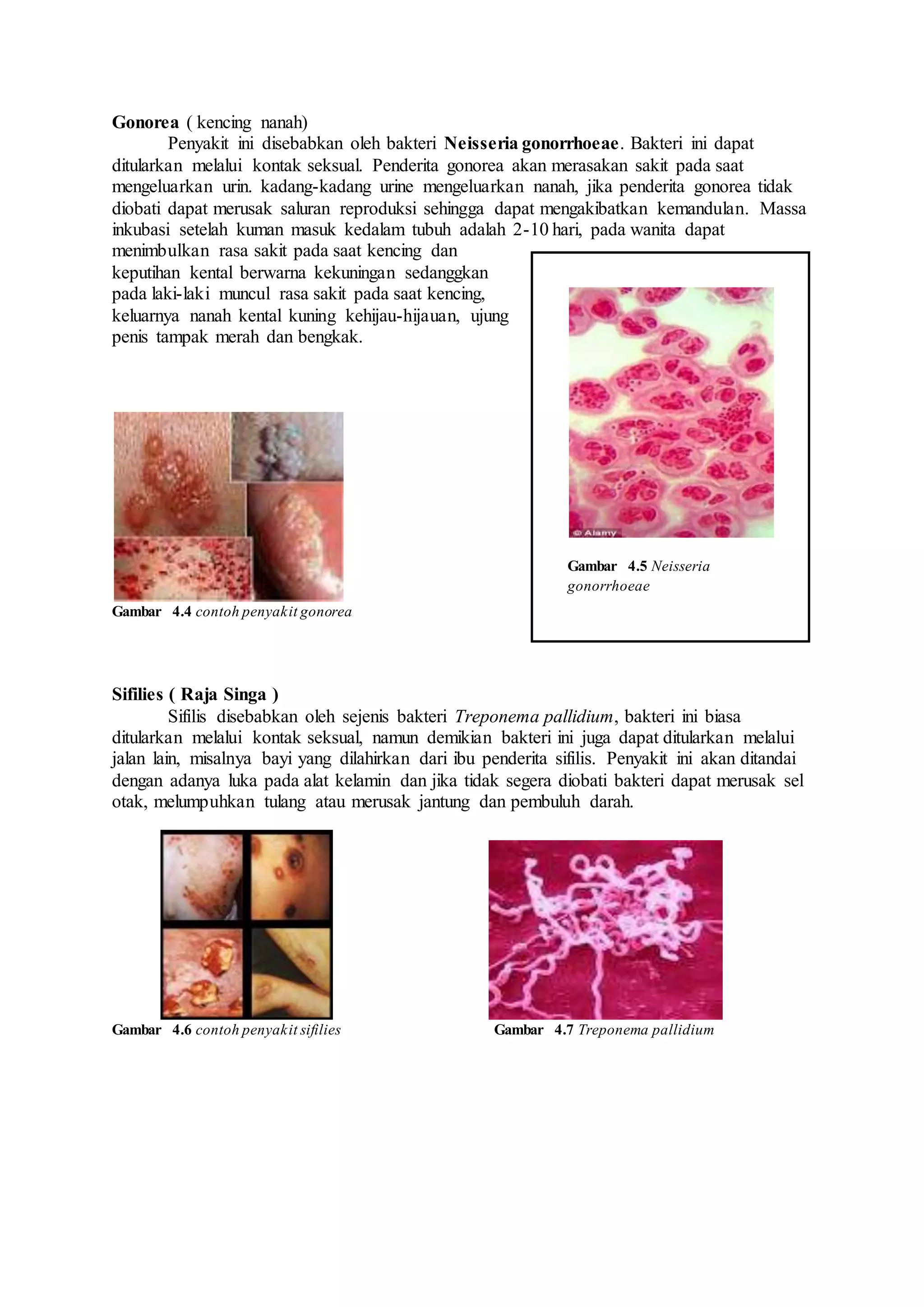 Gonorea ( kencing nanah)
Penyakit ini disebabkan oleh bakteri Neisseria gonorrhoeae. Bakteri ini dapat
ditularkan melalui kontak seksual. Penderita gonorea akan merasakan sakit pada saat
mengeluarkan urin. kadang-kadang urine mengeluarkan nanah, jika penderita gonorea tidak
diobati dapat merusak saluran reproduksi sehingga dapat mengakibatkan kemandulan. Massa
inkubasi setelah kuman masuk kedalam tubuh adalah 2-10 hari, pada wanita dapat
menimbulkan rasa sakit pada saat kencing dan
keputihan kental berwarna kekuningan sedanggkan
pada laki-laki muncul rasa sakit pada saat kencing,
keluarnya nanah kental kuning kehijau-hijauan, ujung
penis tampak merah dan bengkak.
Gambar 4.4 contoh penyakit gonorea
Sifilies ( Raja Singa )
Sifilis disebabkan oleh sejenis bakteri Treponema pallidium, bakteri ini biasa
ditularkan melalui kontak seksual, namun demikian bakteri ini juga dapat ditularkan melalui
jalan lain, misalnya bayi yang dilahirkan dari ibu penderita sifilis. Penyakit ini akan ditandai
dengan adanya luka pada alat kelamin dan jika tidak segera diobati bakteri dapat merusak sel
otak, melumpuhkan tulang atau merusak jantung dan pembuluh darah.
Gambar 4.6 contoh penyakit sifilies Gambar 4.7 Treponema pallidium
Gambar 4.5 Neisseria
gonorrhoeae
 