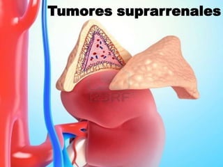 Tumores
suprarrenales
Tumores suprarrenales
 