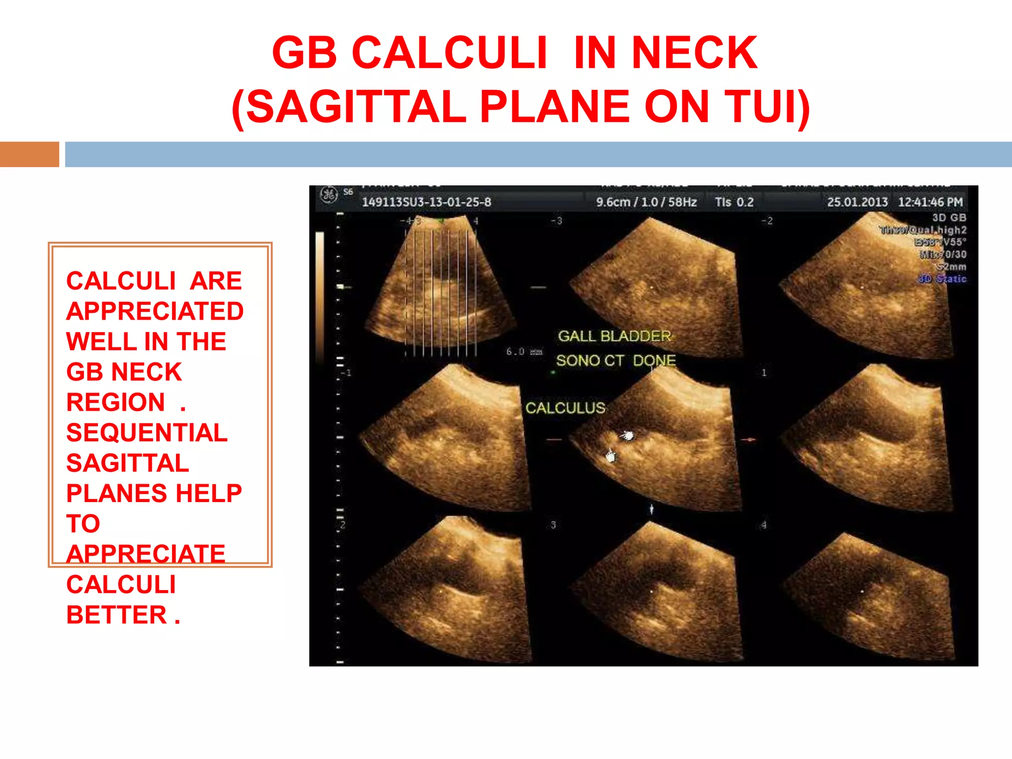 GB CALCULI IN NECK
          (SAGITTAL PLANE ON TUI)


CALCULI ARE
APPRECIATED
WELL IN THE
GB NECK
REGION .
SEQUENTIAL
SAGITTAL
PLANES HELP
TO
APPRECIATE
CALCULI
BETTER .
 
