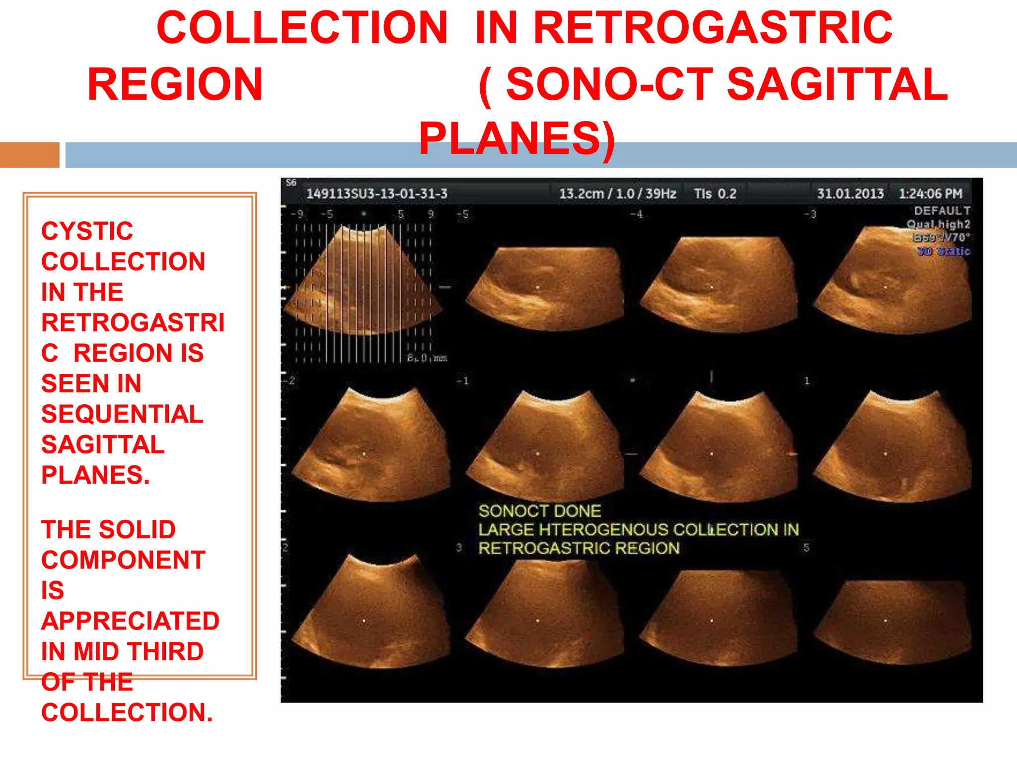 COLLECTION IN RETROGASTRIC
   REGION       ( SONO-CT SAGITTAL
              PLANES)
CYSTIC
COLLECTION
IN THE
RETROGASTRI
C REGION IS
SEEN IN
SEQUENTIAL
SAGITTAL
PLANES.

THE SOLID
COMPONENT
IS
APPRECIATED
IN MID THIRD
OF THE
COLLECTION.
 