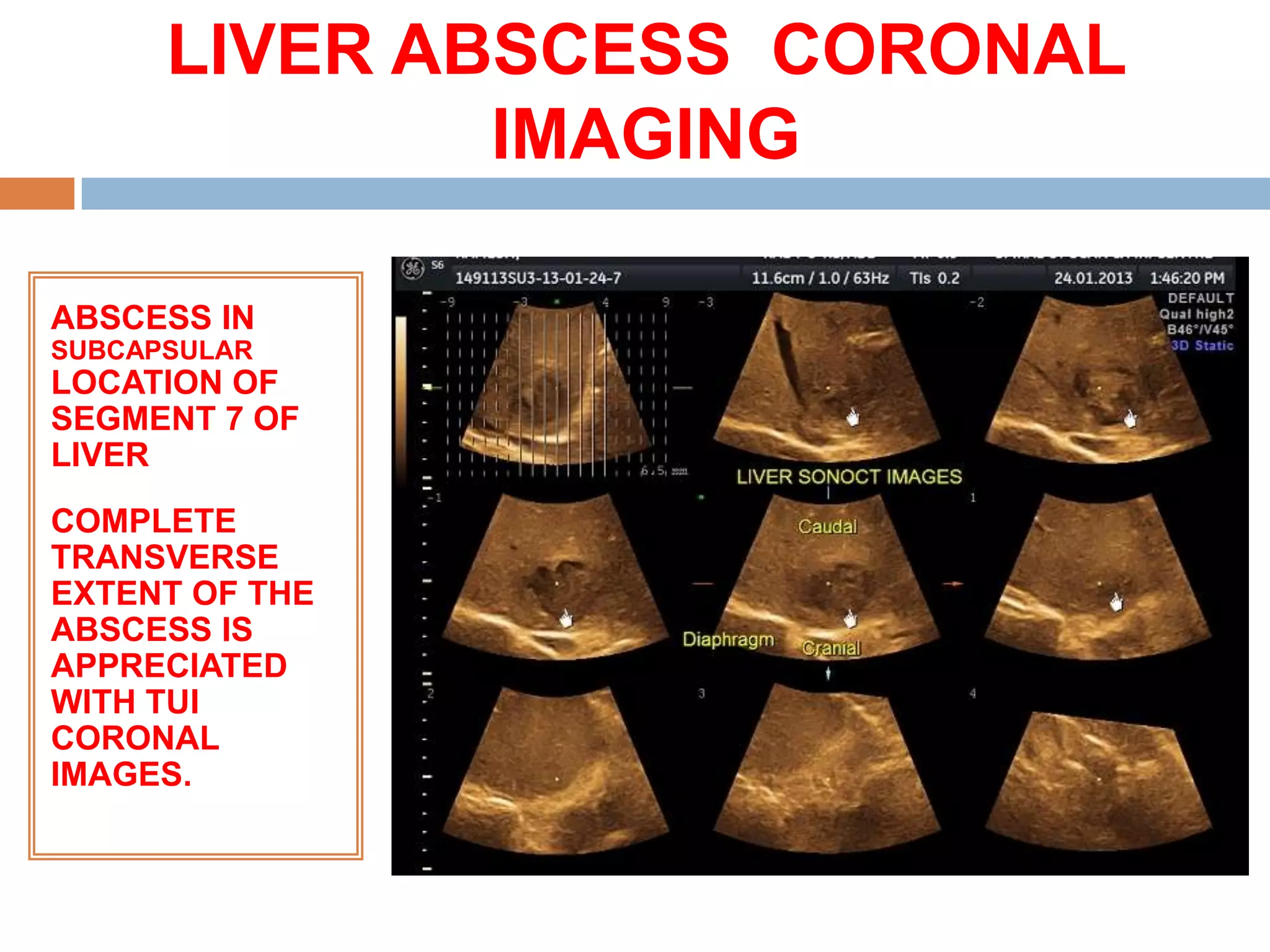 LIVER ABSCESS CORONAL
              IMAGING

ABSCESS IN
SUBCAPSULAR
LOCATION OF
SEGMENT 7 OF
LIVER
COMPLETE
TRANSVERSE
EXTENT OF THE
ABSCESS IS
APPRECIATED
WITH TUI
CORONAL
IMAGES.
 