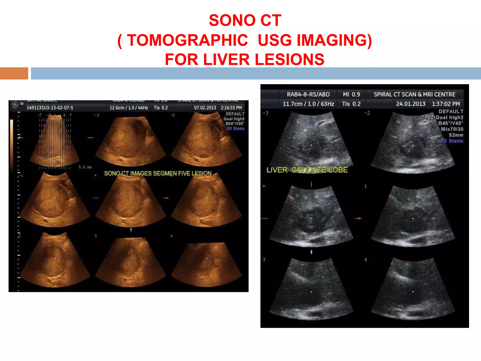 SONO CT
( TOMOGRAPHIC USG IMAGING)
     FOR LIVER LESIONS
 