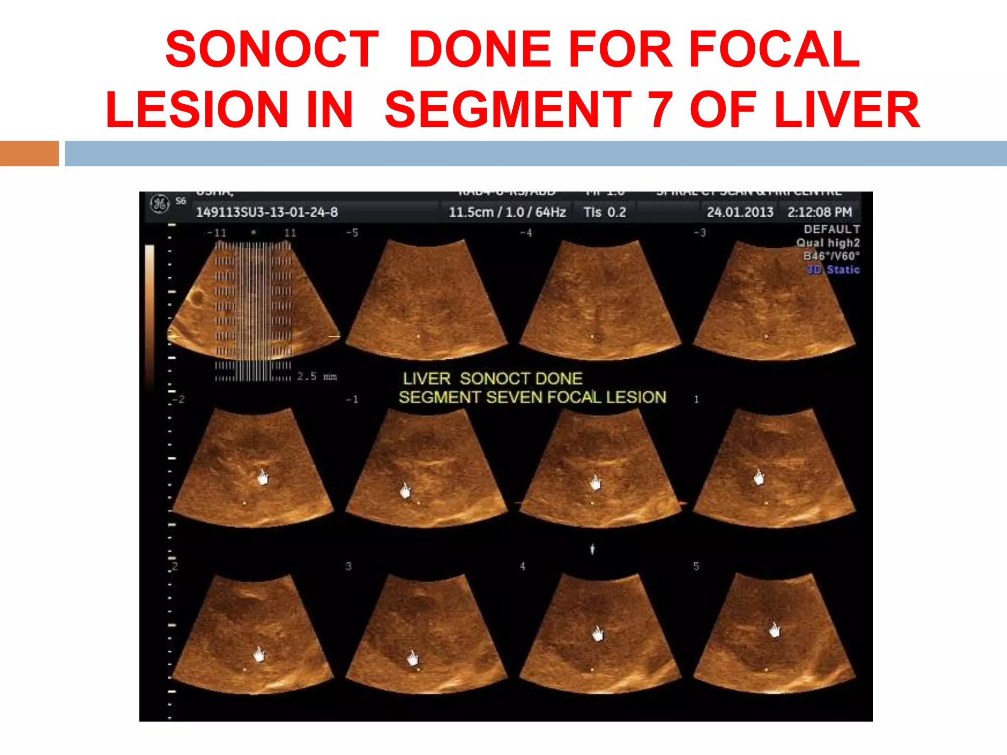 SONOCT DONE FOR FOCAL
LESION IN SEGMENT 7 OF LIVER
 