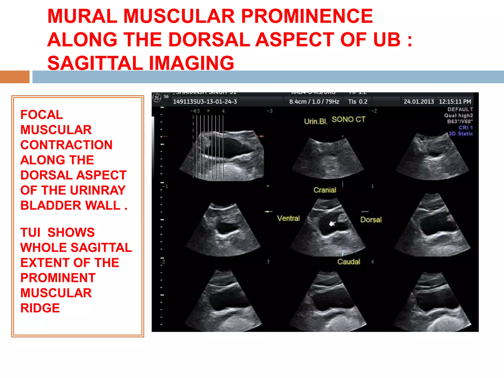 MURAL MUSCULAR PROMINENCE
   ALONG THE DORSAL ASPECT OF UB :
   SAGITTAL IMAGING

FOCAL
MUSCULAR
CONTRACTION
ALONG THE
DORSAL ASPECT
OF THE URINRAY
BLADDER WALL .

TUI SHOWS
WHOLE SAGITTAL
EXTENT OF THE
PROMINENT
MUSCULAR
RIDGE
 