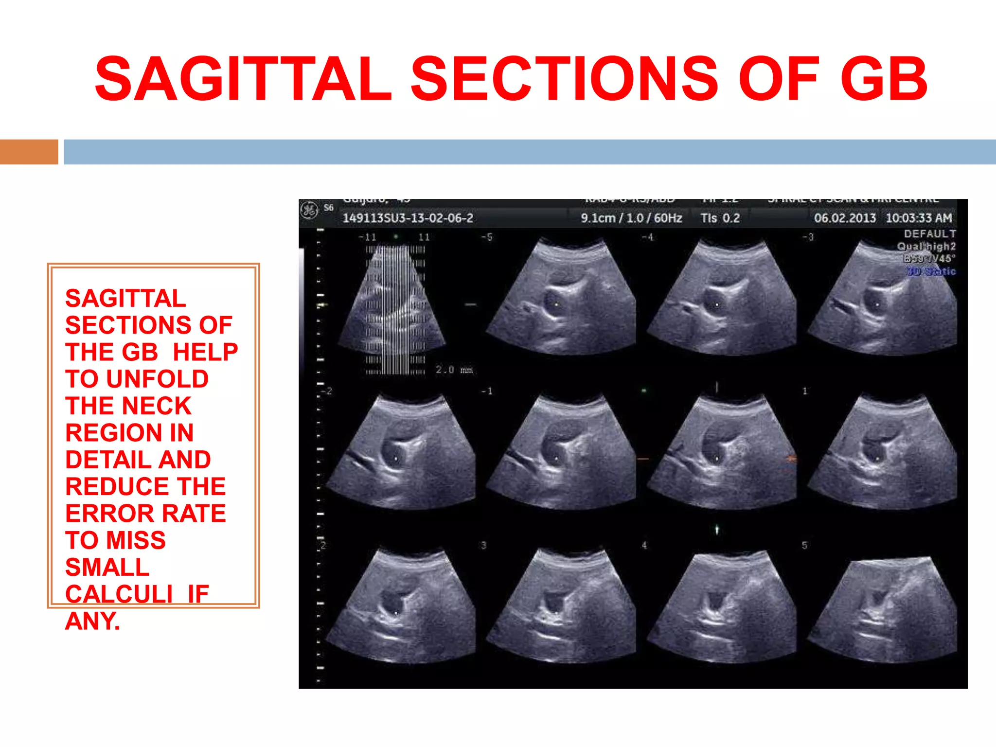 SAGITTAL SECTIONS OF GB


SAGITTAL
SECTIONS OF
THE GB HELP
TO UNFOLD
THE NECK
REGION IN
DETAIL AND
REDUCE THE
ERROR RATE
TO MISS
SMALL
CALCULI IF
ANY.
 