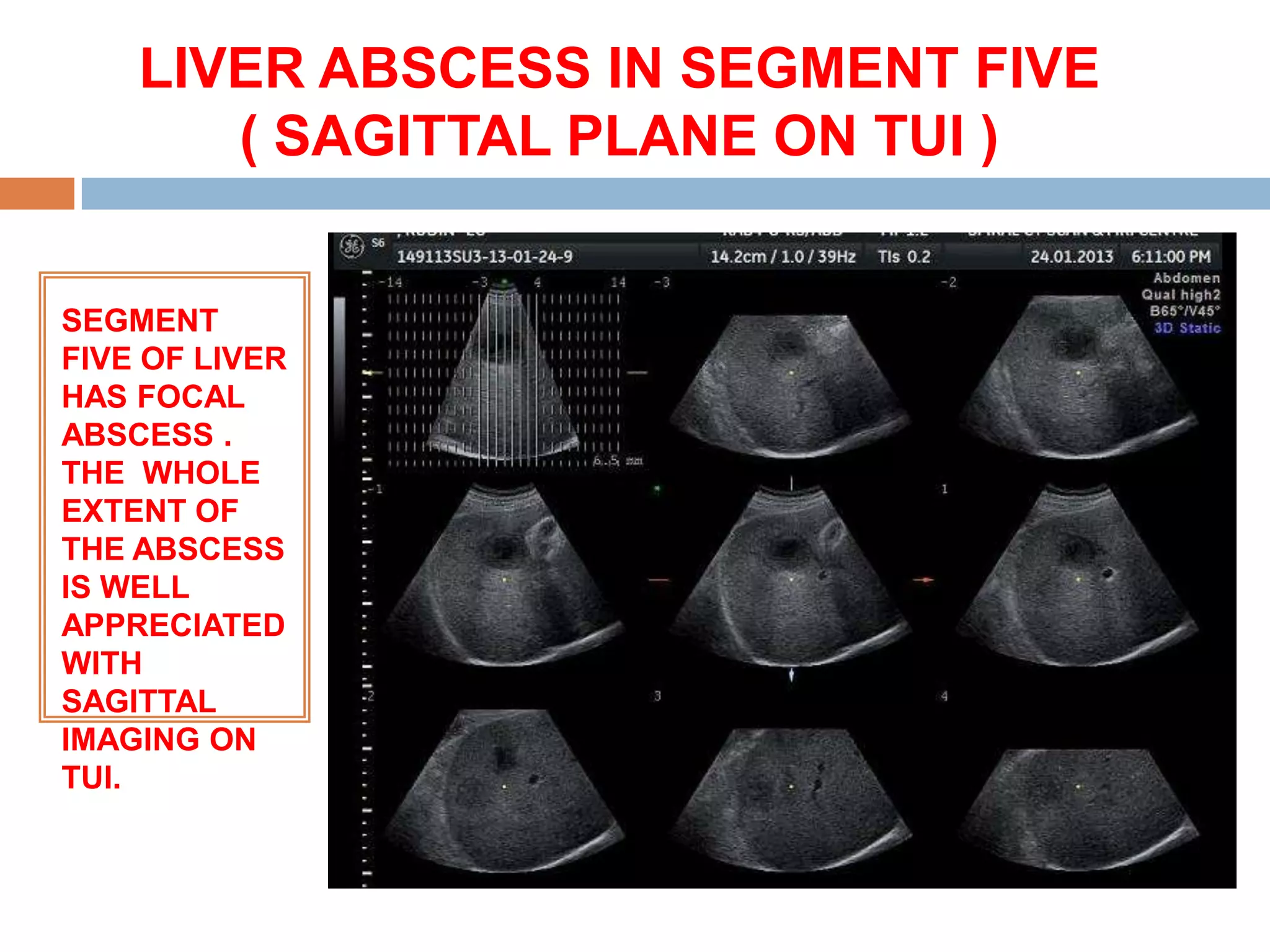 LIVER ABSCESS IN SEGMENT FIVE
       ( SAGITTAL PLANE ON TUI )


SEGMENT
FIVE OF LIVER
HAS FOCAL
ABSCESS .
THE WHOLE
EXTENT OF
THE ABSCESS
IS WELL
APPRECIATED
WITH
SAGITTAL
IMAGING ON
TUI.
 