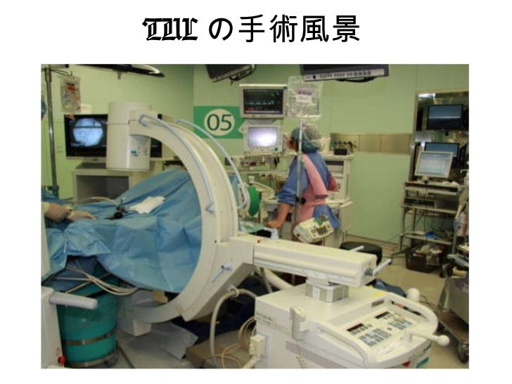 尿路結石 tul経尿道的尿管結石砕石術