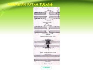 SUBOWOSUBOWO
PERBAIKAN PATAH TULANG
 