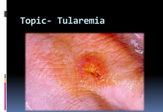 Topic- Tularemia
 