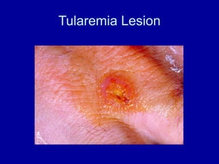 Tularemia Lesion
 